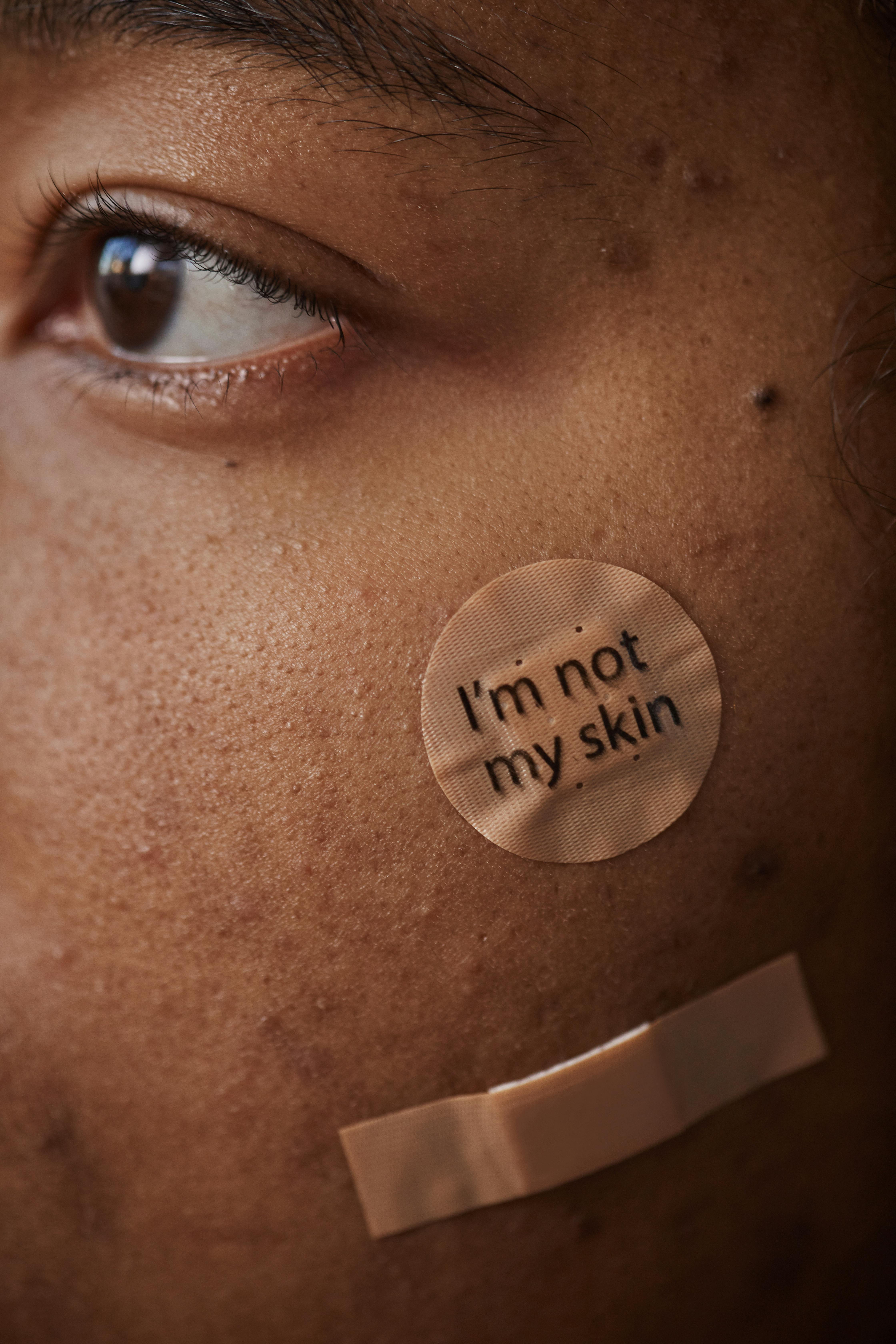 Acne Treatment Results